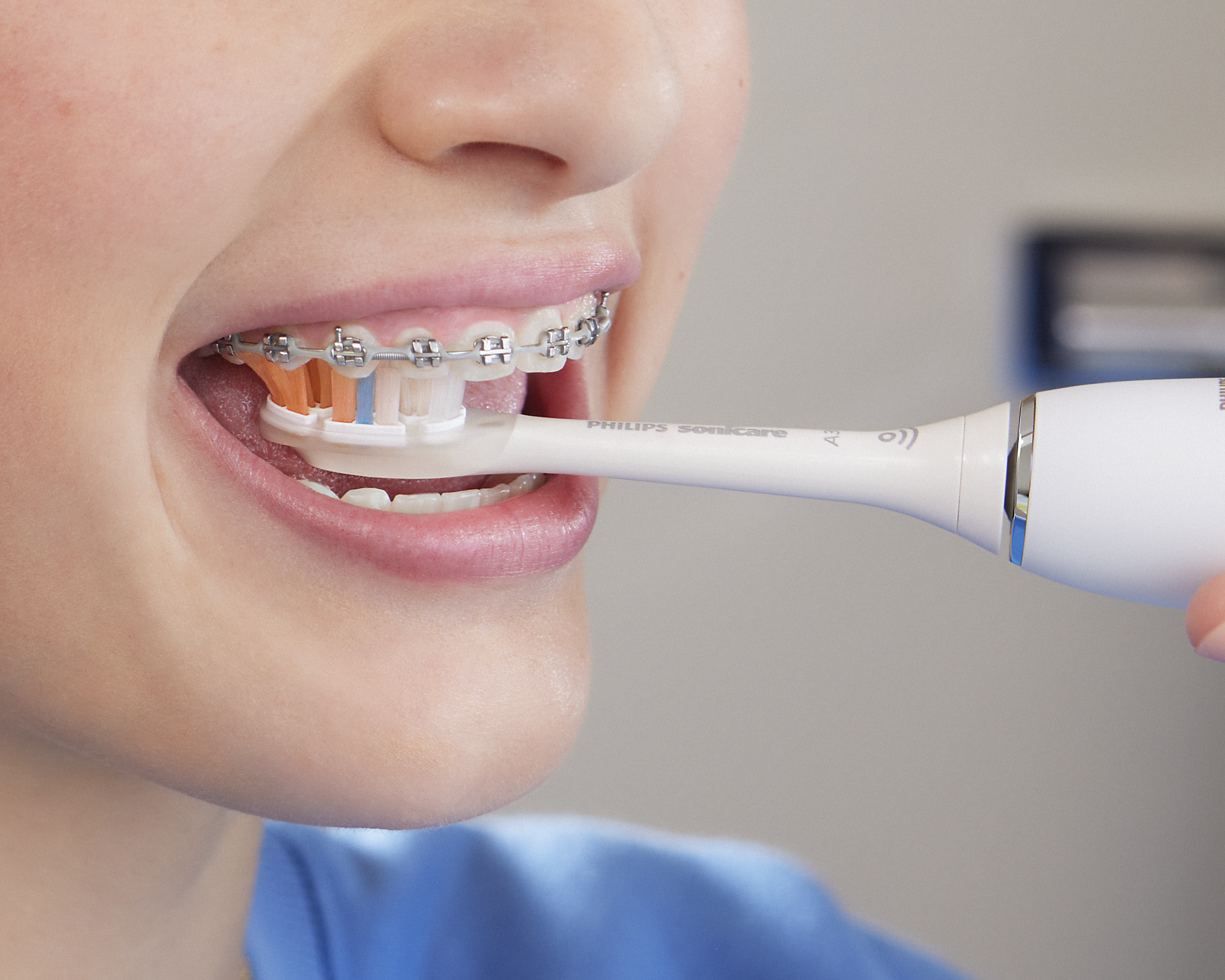 Patient with braces brushing top teeth.