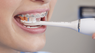 Patient with braces brushing top teeth.