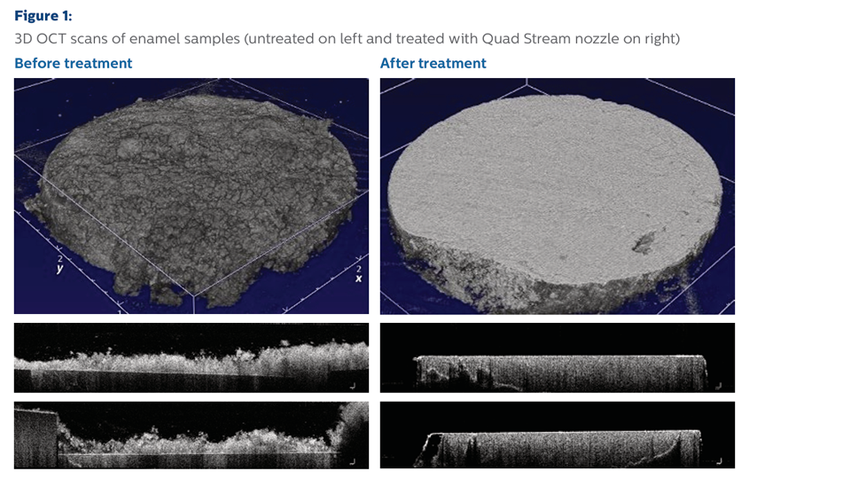 Figure 1:  3D OCT scans of enamel samples (untreated on left and treated with Quad Stream nozzle on right) 