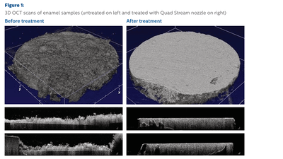 Figure 1: 3D OCT scans of enamel samples (untreated on left and treated with Quad Stream nozzle on right)
