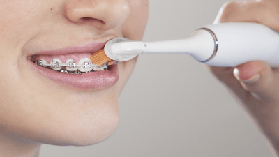 Patient with braces brushing top of front braces.