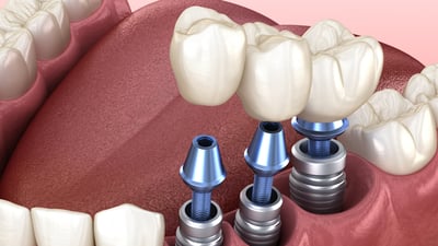 despre-implantul-dentar