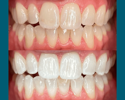 Improves appearance