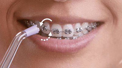 Patient with braces brushing front teeth.