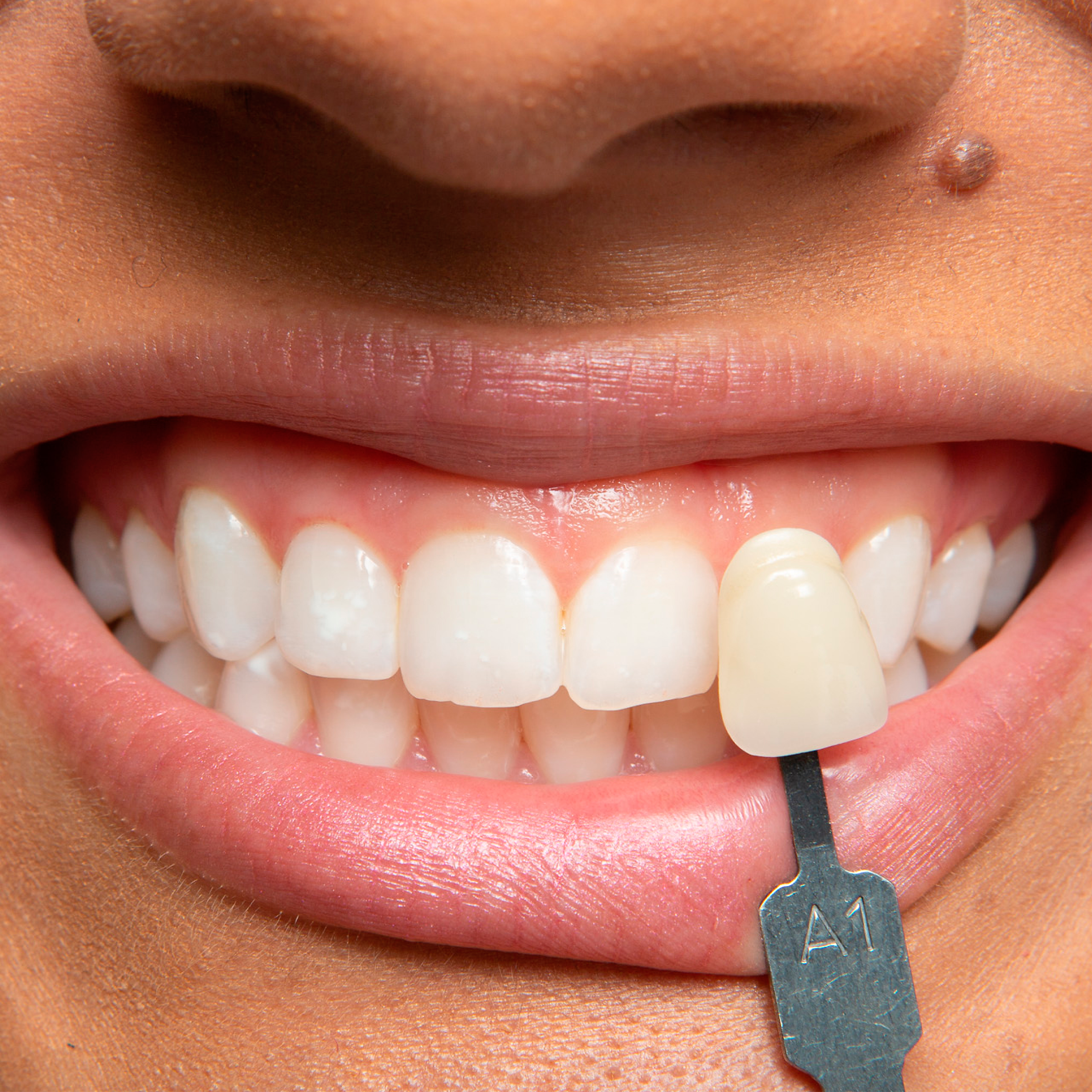 A patient comparing their teeth to a shade guide instrument.