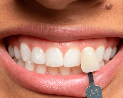 Un patient comparant la teinte de ses dents à un guide de teintes.
