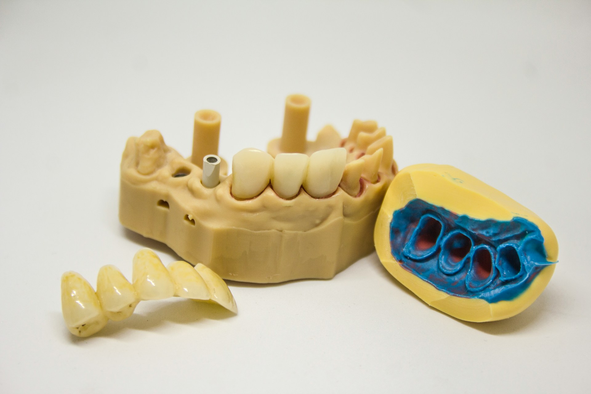 coroana-dentara-dinti-perfecti-6SAzfKla3IE.jpg