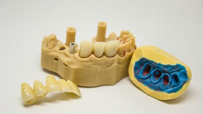 coroana-dentara-dinti-perfecti-6SAzfKla3IE.jpg