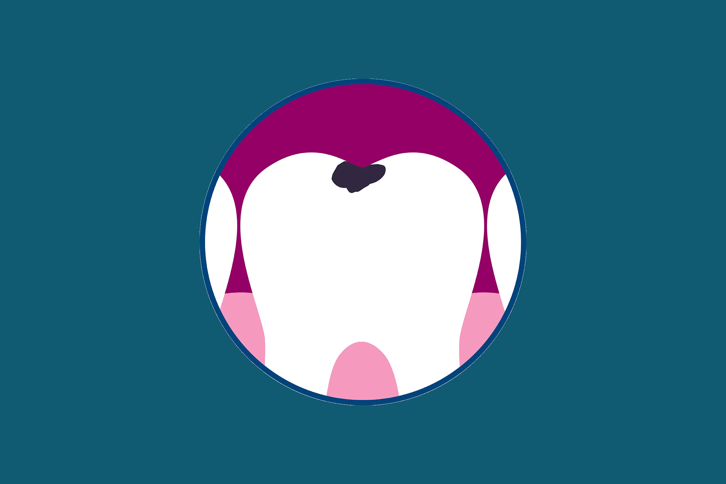 graphic of caries