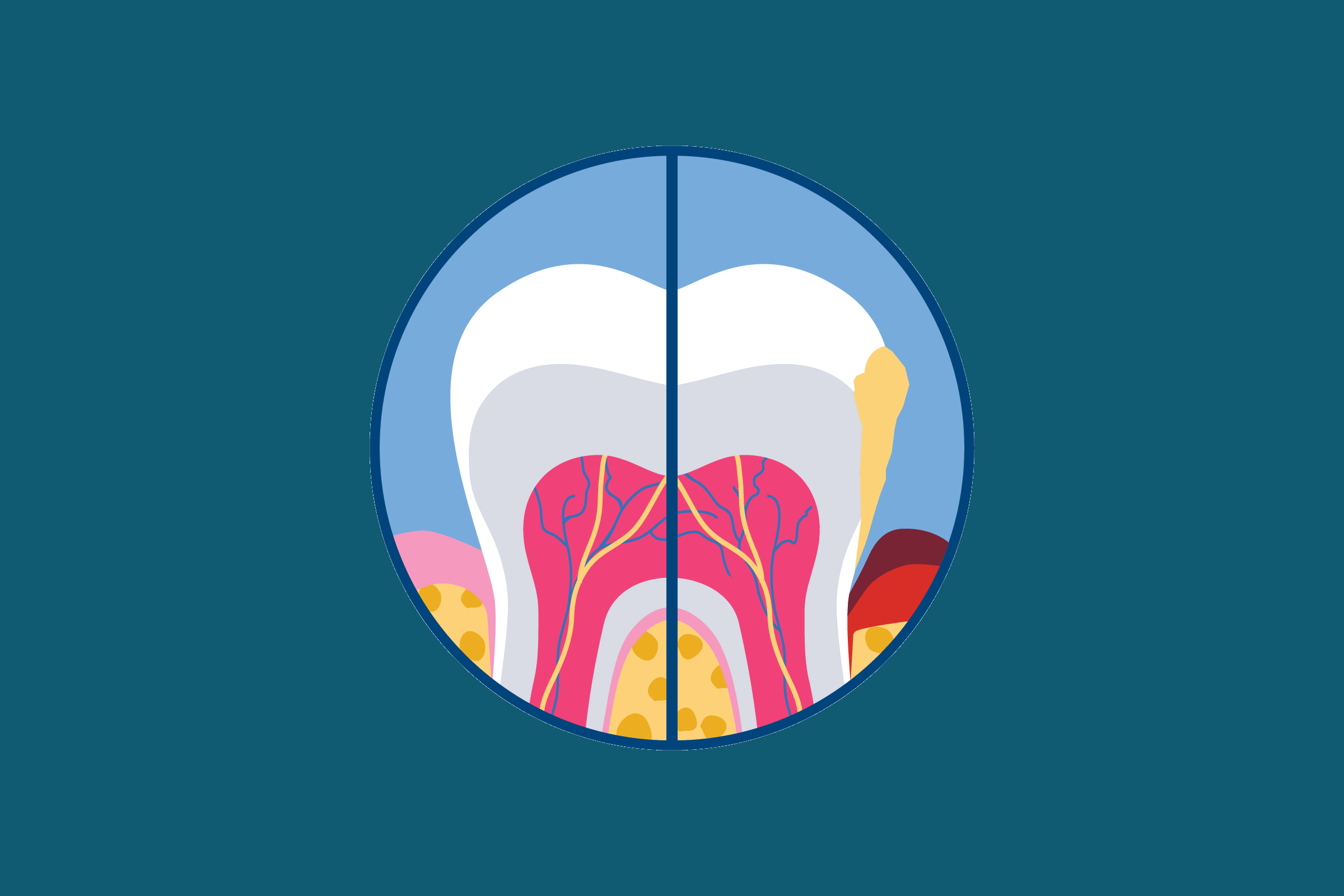 graphic of periodontitis