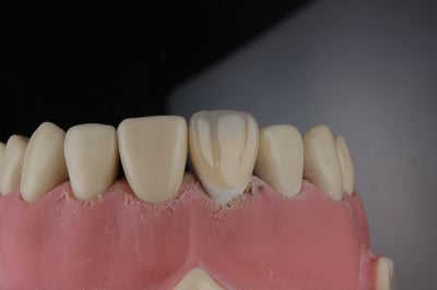 articulator-tehnica-dentara-dinte-pata-alba