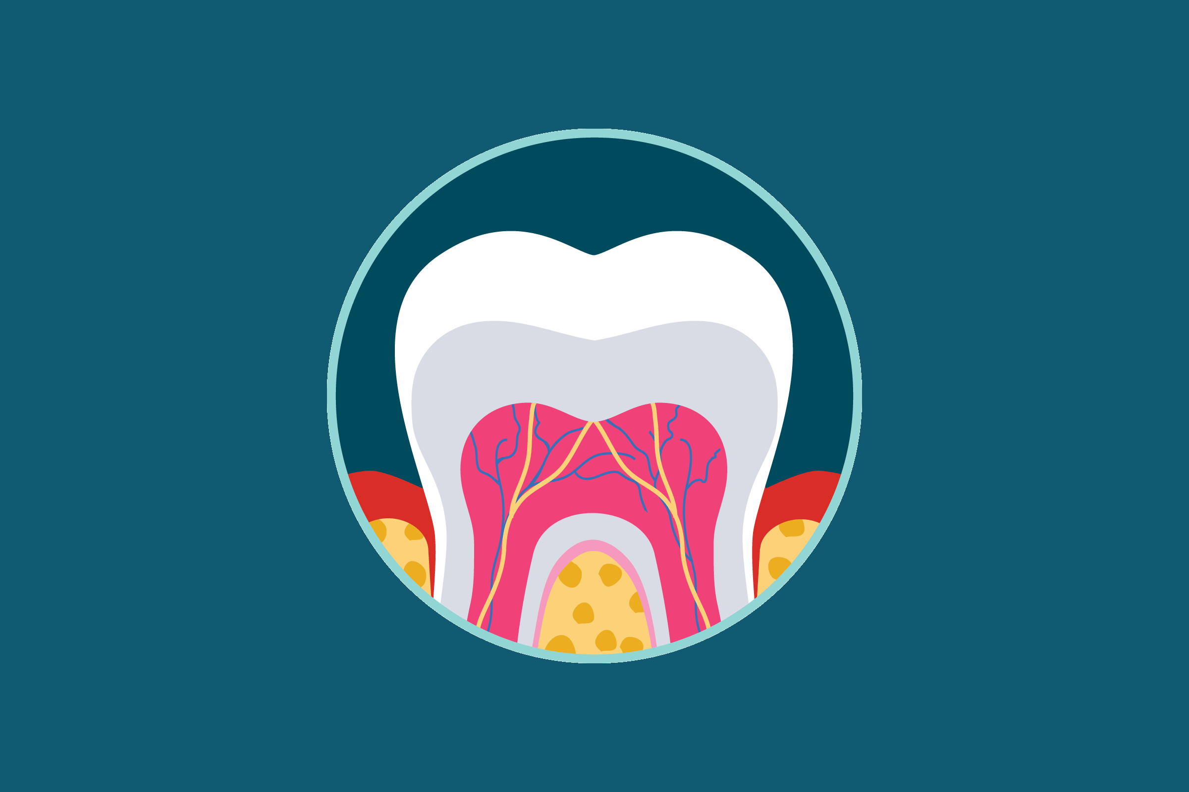 graphic of gingivitis