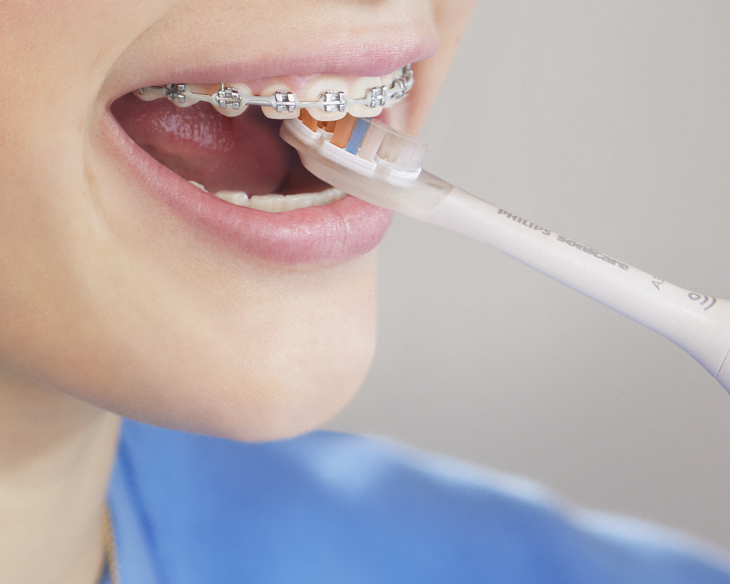 Patient with braces brushing back of front teeth.