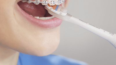 Patient with braces brushing back of front teeth.