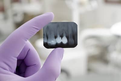 Parodontitida, lidově „paradentóza“ – příznaky a léčba