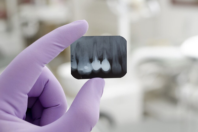 Parodontóza a vypadávanie zubov - príčiny a liečba