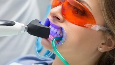 Професійне чищення зубів і видалення плям