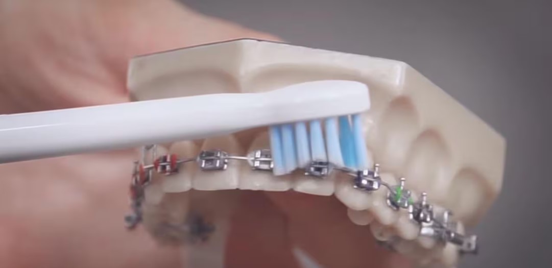 Ako si čistiť zuby s fixným strojčekom? 