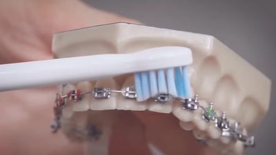 Jak čistit s rovnátky