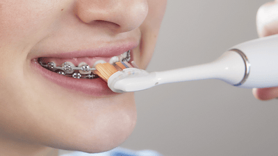 Patient with braces brushing front of braces.