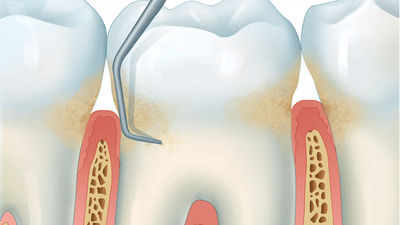 Image of tooth and gum