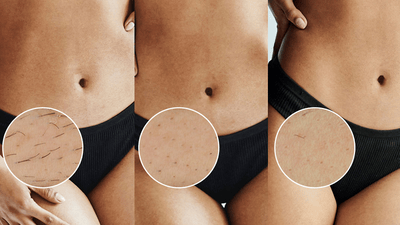 Результати фотоепілятора Lumea на бікіні