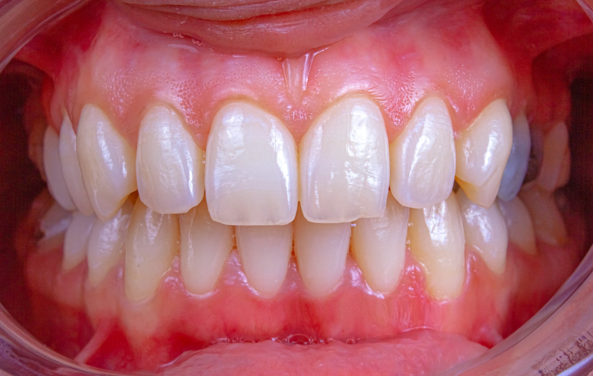 dantura-adult-dinte-inegrit-enO4DQOQu7k.jpg