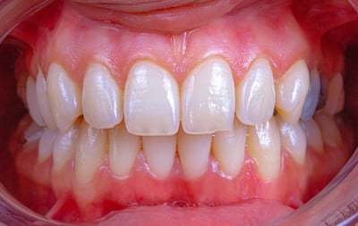 dantura-adult-dinte-inegrit-enO4DQOQu7k.jpg