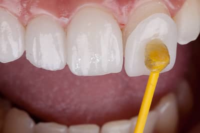 Poți îndepărta singur tartrul dentar? Cum să scapi de placă și tartru între vizitele la dentist