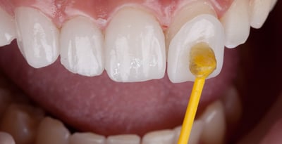 dental facets
