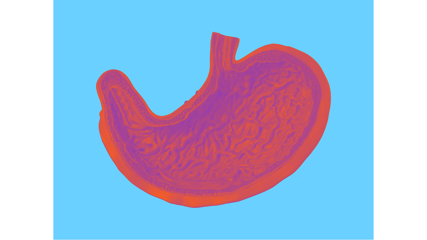 A stylised anatomical illustration of the human stomach in warm orange and magenta tones on a bright cyan background, revealing the folded interior mucosal wall. Serves as the visual identifier for the Crohn's Disease condition card.