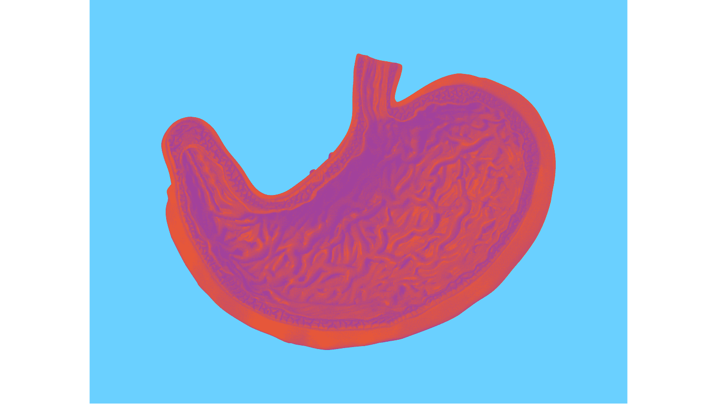 Stylised anatomical illustration of the human stomach interior A stylised anatomical illustration of the human stomach in warm orange and magenta tones on a bright cyan background, revealing the folded interior mucosal wall. Serves as the visual identifier for the Crohn's Disease condition card.