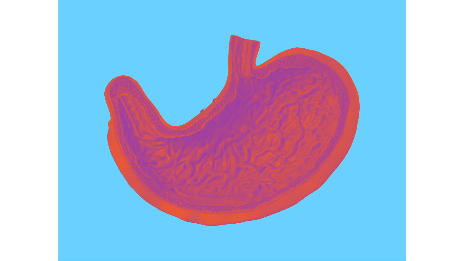 crohn-disease-ibd