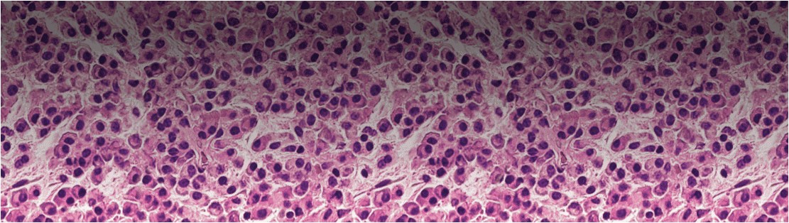Comprendere il Mieloma Multiplo