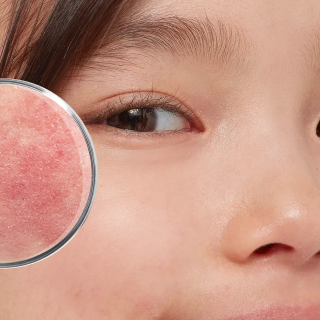 Derma_geirriteerde_rode_huid_afbeelding.png Derma_geirriteerde_rode_huid_afbeelding.png